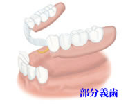 部分義歯