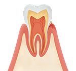 軽度の歯周病