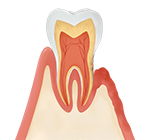 中度の歯周病