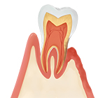 重度の歯周病